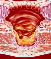 Ulcera Gastro-duodenal